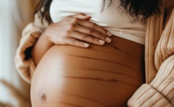 Stretch Marks: Get Set Go!