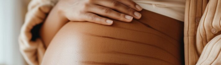 Stretch Marks: Get Set Go!