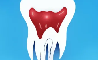 What Causes the Need for a Root Canal?