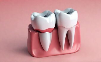 Top 7 Benefits of Dental Implants