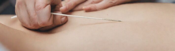 NYC’s Leading Acupuncturist Explains How Getting Needled Can Help You Get Pregnant