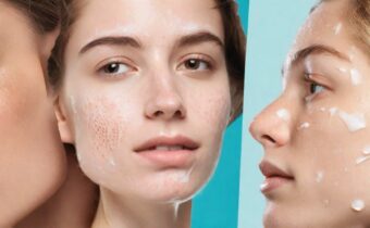 The Best Drugstore Acne Scar Treatments, According to Dermatologists