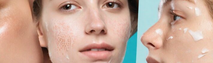 The Best Drugstore Acne Scar Treatments, According to Dermatologists