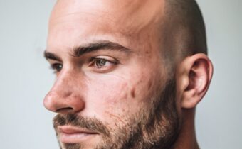 Tips to Get Rid of Bald Patches on Your Scalp