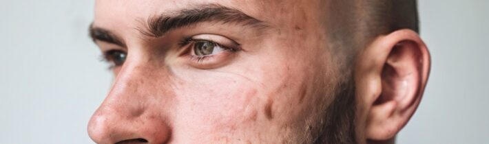 Tips to Get Rid of Bald Patches on Your Scalp