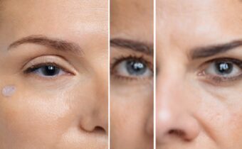 Under-Eye Filler: What to Consider Before the Procedure