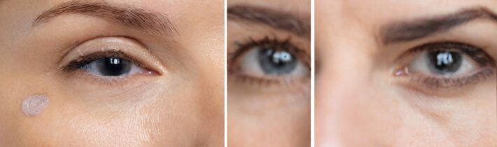 Under-Eye Filler: What to Consider Before the Procedure