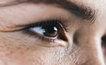 Understanding Genetic Dark Circles and How to Address Them