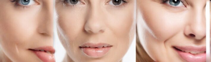 Why Juvederm Fillers is So Popular