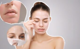 Complete Guide to Treating Acne