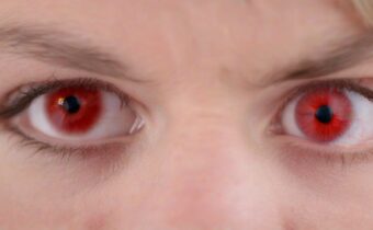 Dealing with Allergy-Related Red Eyes
