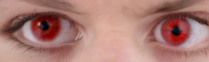 Dealing with Allergy-Related Red Eyes