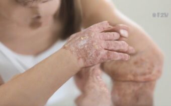 Foundation Solutions for Psoriasis