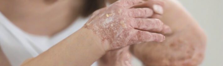 Foundation Solutions for Psoriasis