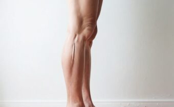 Height and Varicose Veins