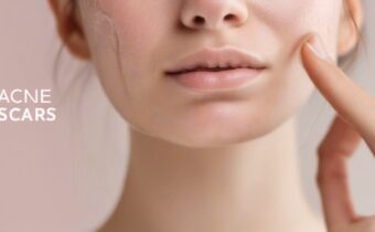 Minimizing Acne Scars Tips