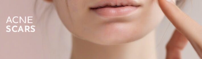Minimizing Acne Scars Tips