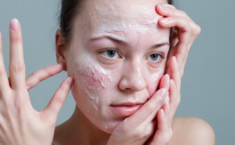 Understanding Atopic Dermatitis