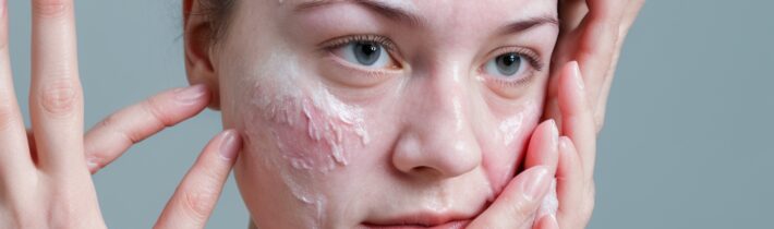 Understanding Atopic Dermatitis