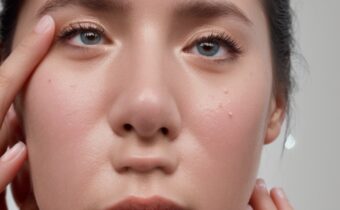 Niacinamide for Oily Skin