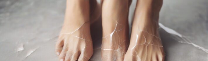 Understanding Cracked Heels