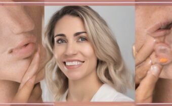 The Hormones-Hyperpigmentation Connection