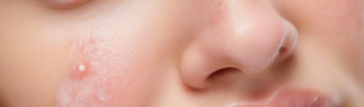 Cold Sore or Lip Pimple? Here’s How to Tell the Difference